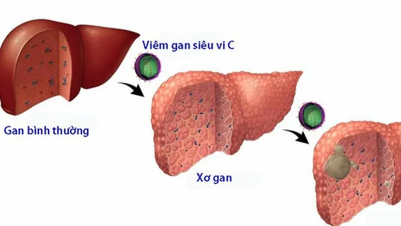 Phân tích các giai đoạn bệnh lý ảnh hưởng đến tài chính điều trị